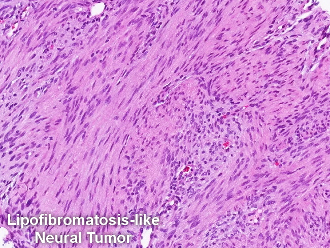Lipofibromatosis-like Neural Tumor1_cropped.jpg